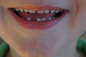 tooth-gap-2019489_1920